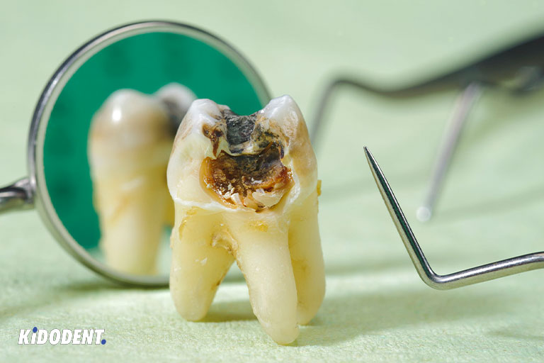 Tooth cavities