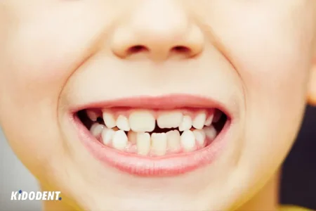 children crooked teeth