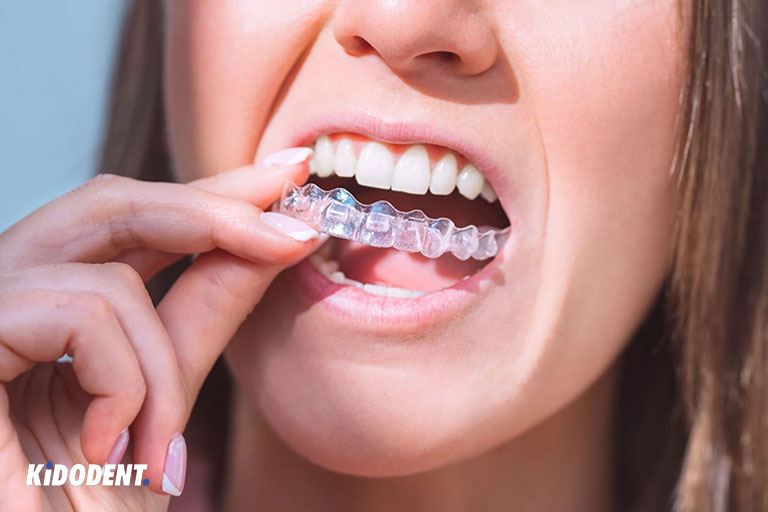 does-insurance-cover-invisalign-invisible-braces-kidodent