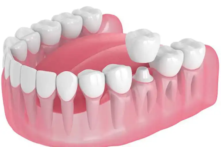 Tooth crown cost