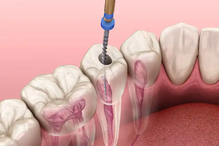 root canal procedure