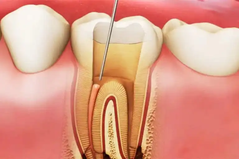 how long does a root canal take?