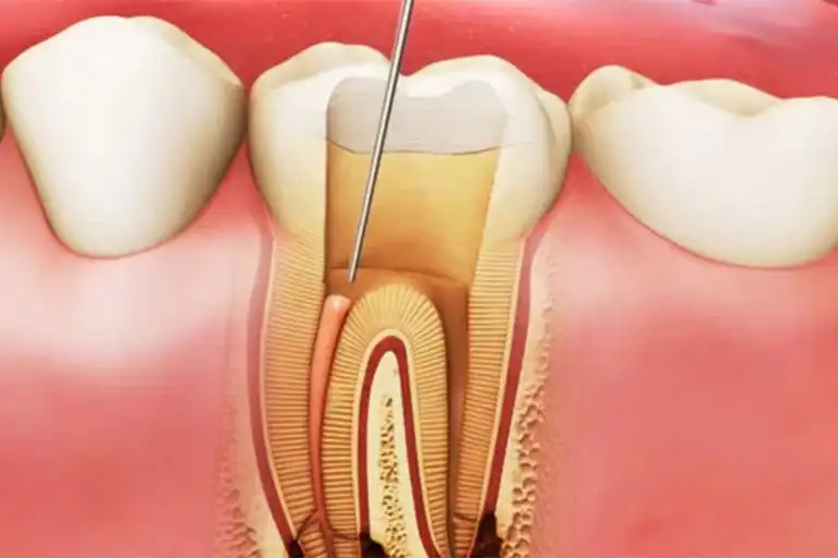 root canal procedure