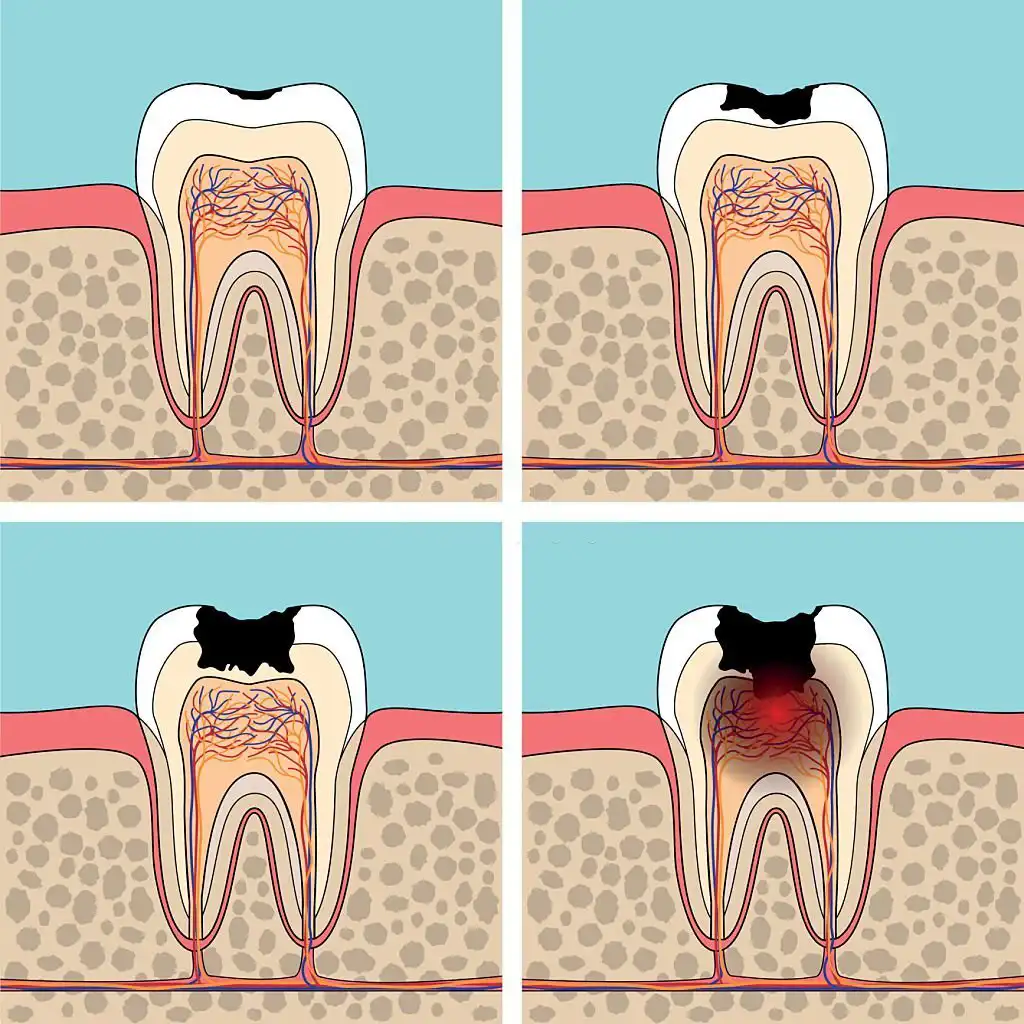 Tooth pulp infcetion