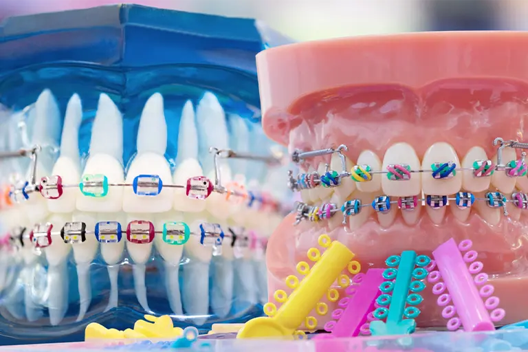 Braces colors wheel