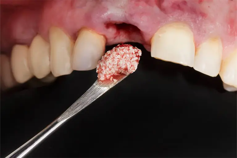 bone spur after tooth extraction