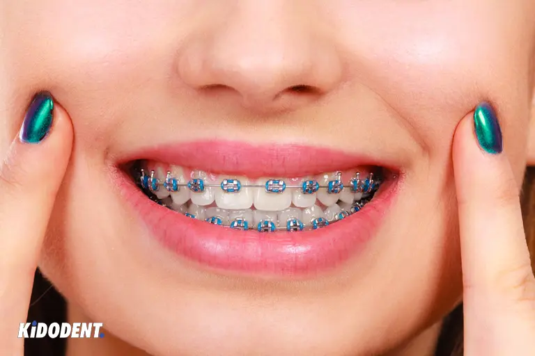 Braces colors for girl