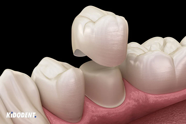 Tooth crown preparation