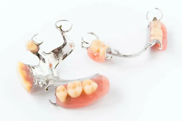 cast metal partial dentures