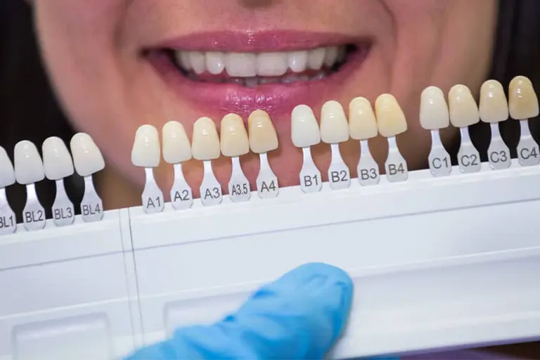composite bonding teeth shades 