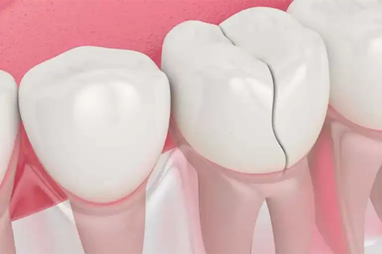 cracked tooth causes