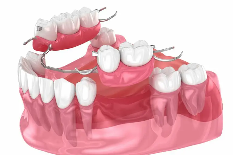 flipper tooth cost and alternatives