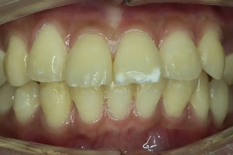 Fluorosis: chalky white spots