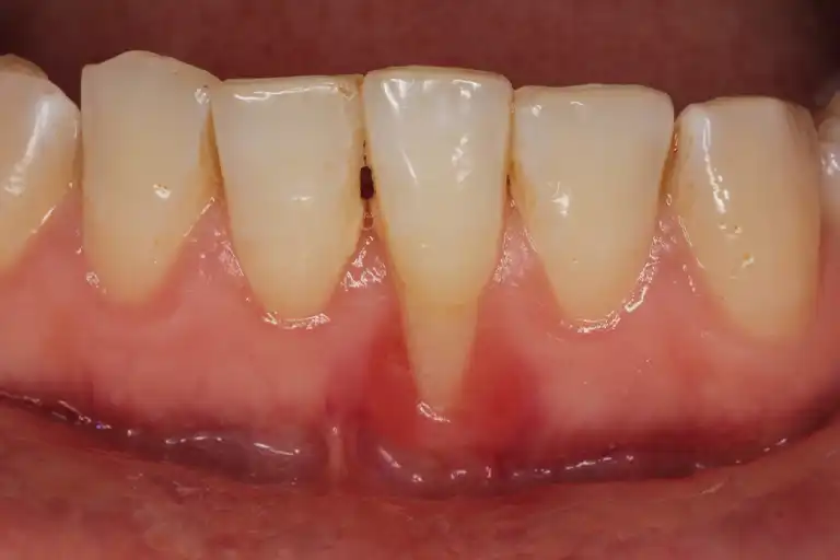 receding gums causes the roots to be exposed