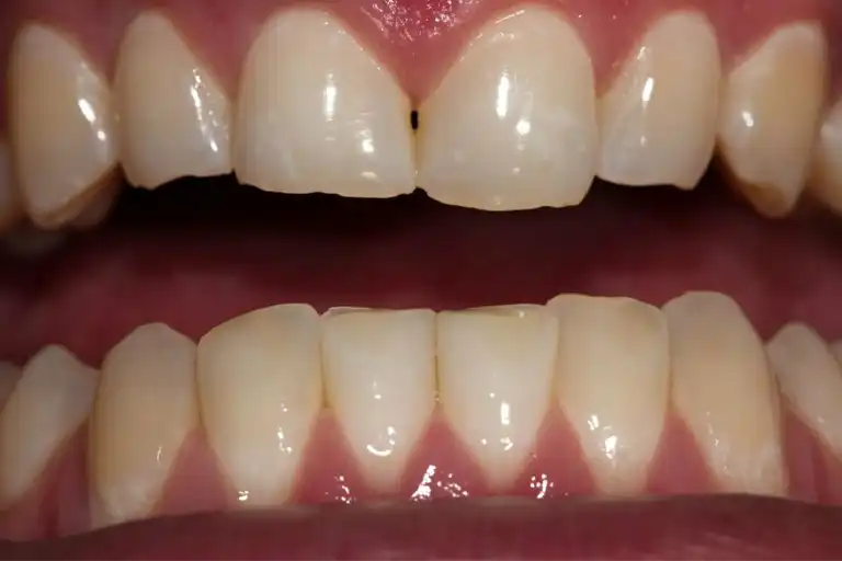 exposed tooth root picture