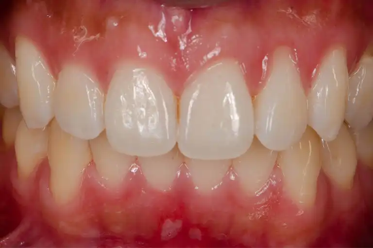 What does exposed tooth look like