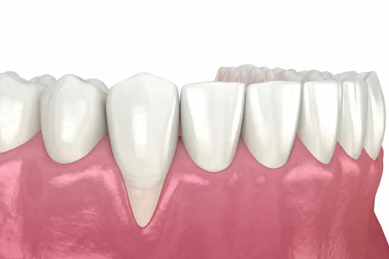 exposed tooth root treatment