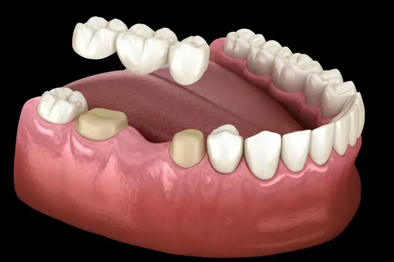 Fixed dental bridge