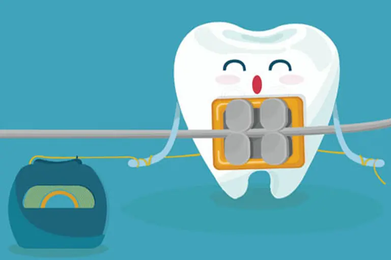 How Do You Floss With a Permanent Retainer? - kidodent