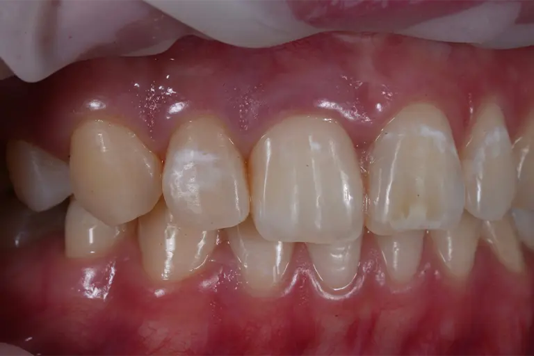 White faints and flecks on teeth symptoms of dental fluorosis