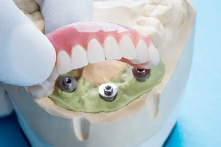 Implant supported dentures