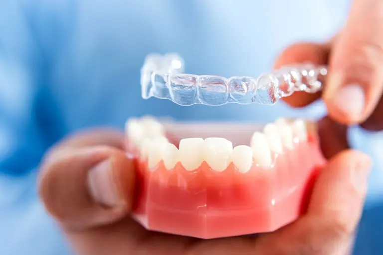Do you have to brush your teeth every time you eat with Invisalign? 