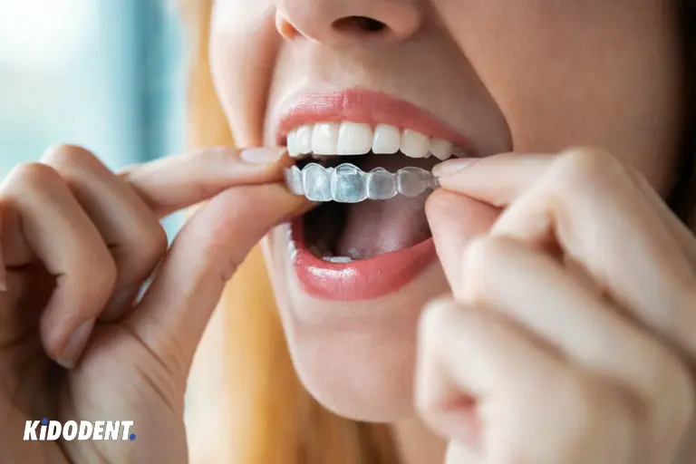 Invisalign clear aligners