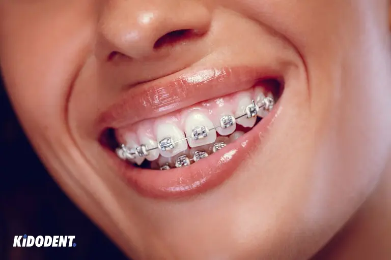 Metal braces are the most common types of braces