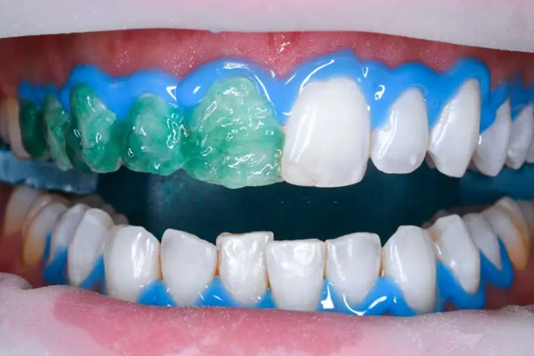 Opalescence teeth whitening in office
