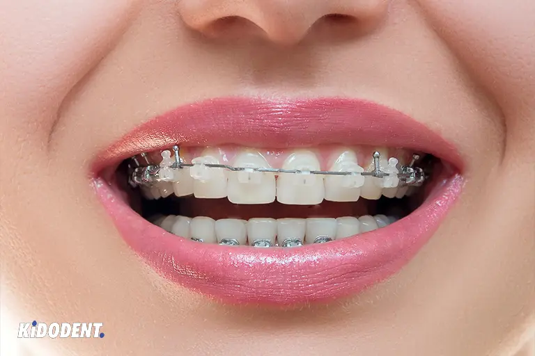 ceramic braces pros and cons