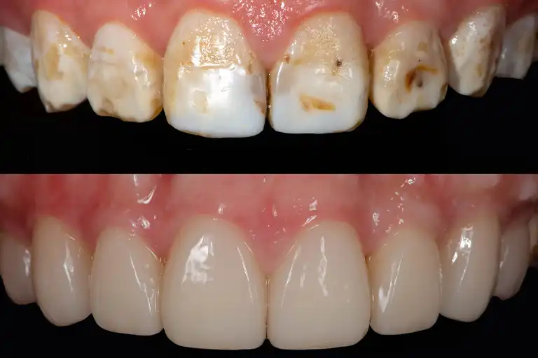 Severe fluorosis treatment with porcelain veneers