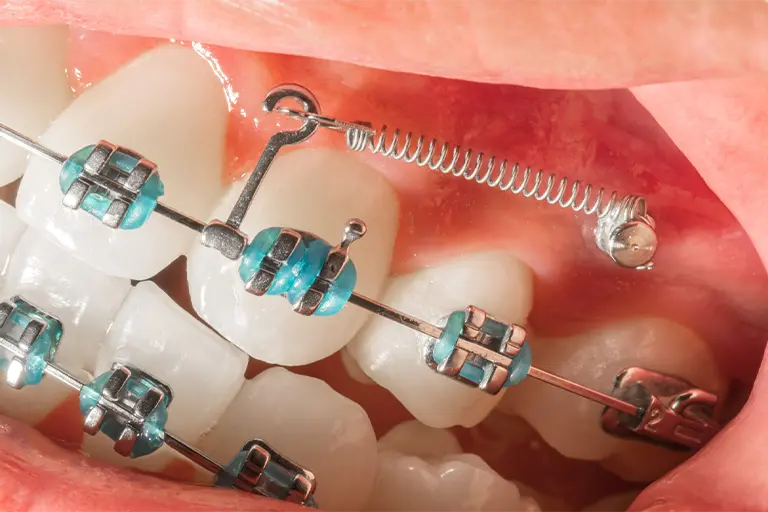 Anchorage in orthodontics: mini-implants 