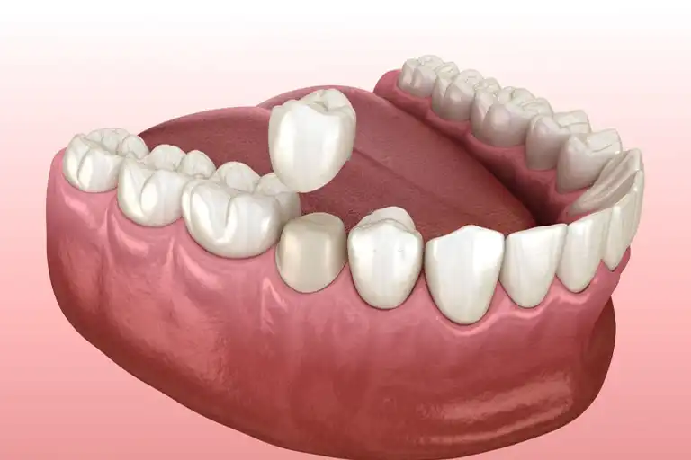 Tooth crown pain relief