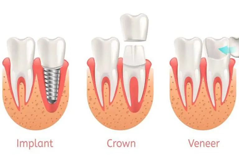 chipped, cracked, broken tooth repair with dental crown, veneers, or dental implant