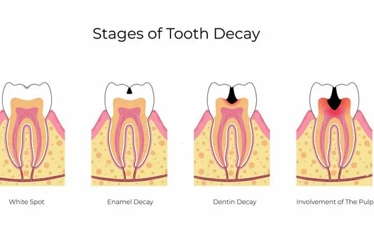 Demineralized enamel (white spots on teeth) is the sign of early development of tooth decay