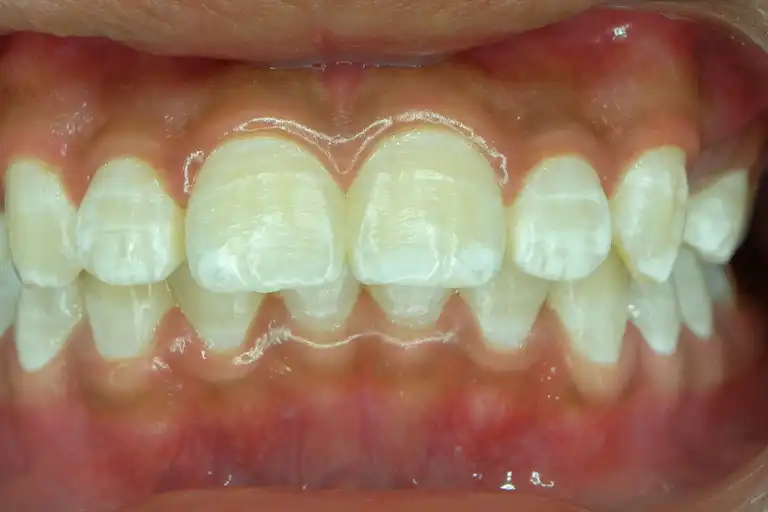 Dental fluorosis: scattered white spots 