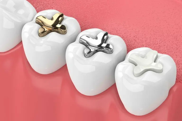 Tooth decay treatment with onlay-inlay filling