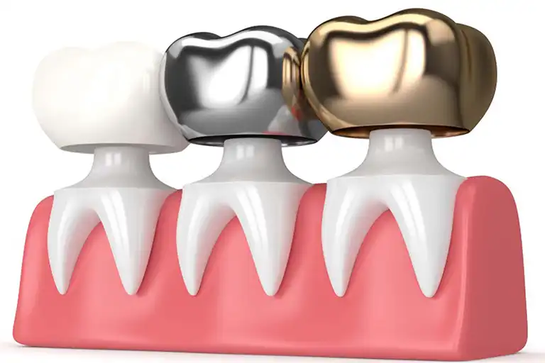 types of dental crowns and cost
