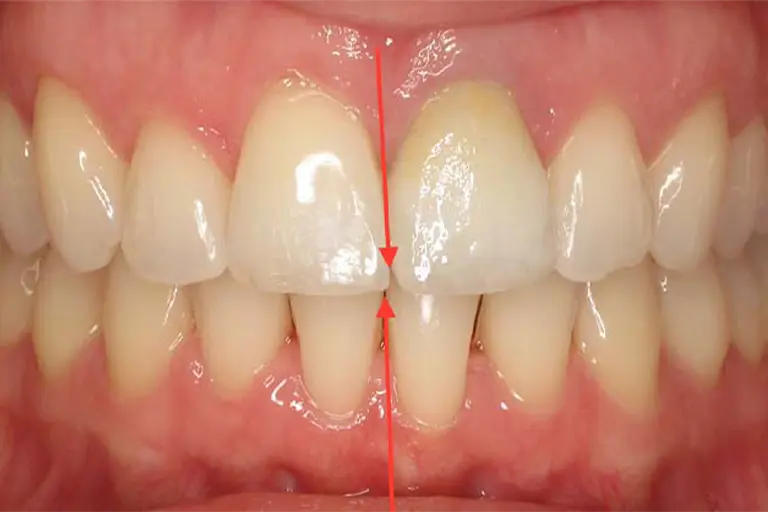 orthodontic problems: midlines