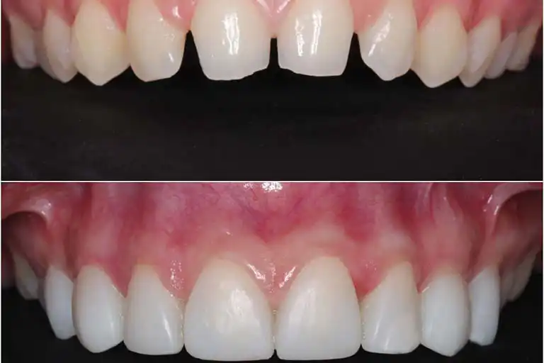 composite veneers before and after