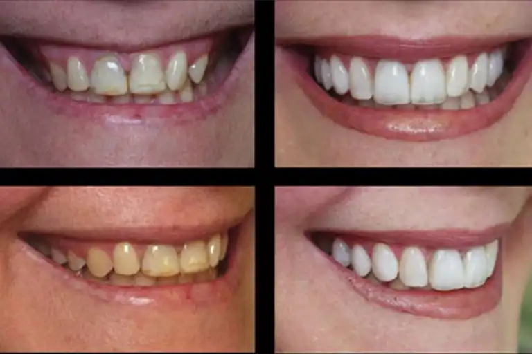 Composite veneers before and after pictures