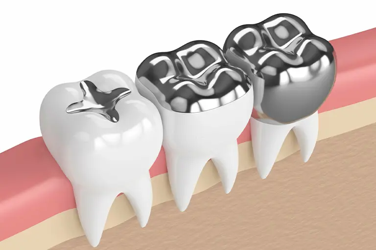 Dental inlays and onlays vs filling vs crown