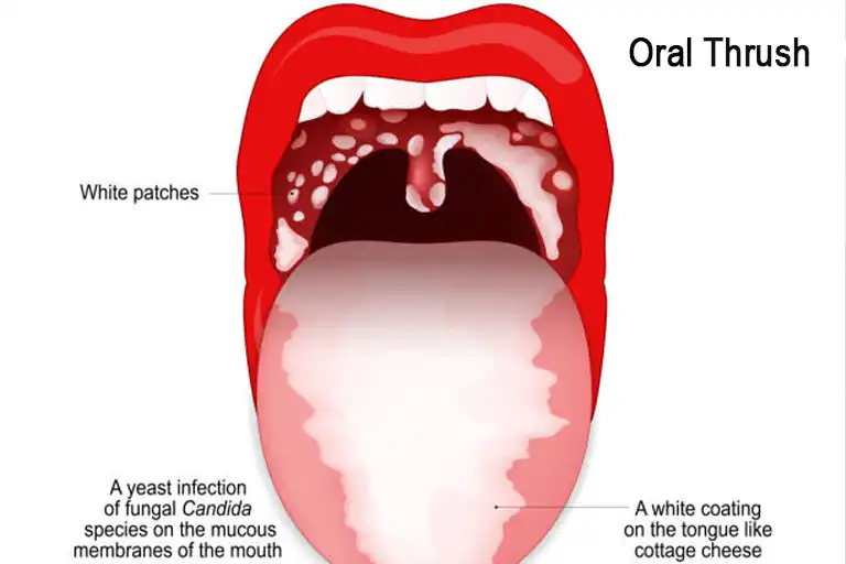 What causes oral thrush and what are the symptoms?