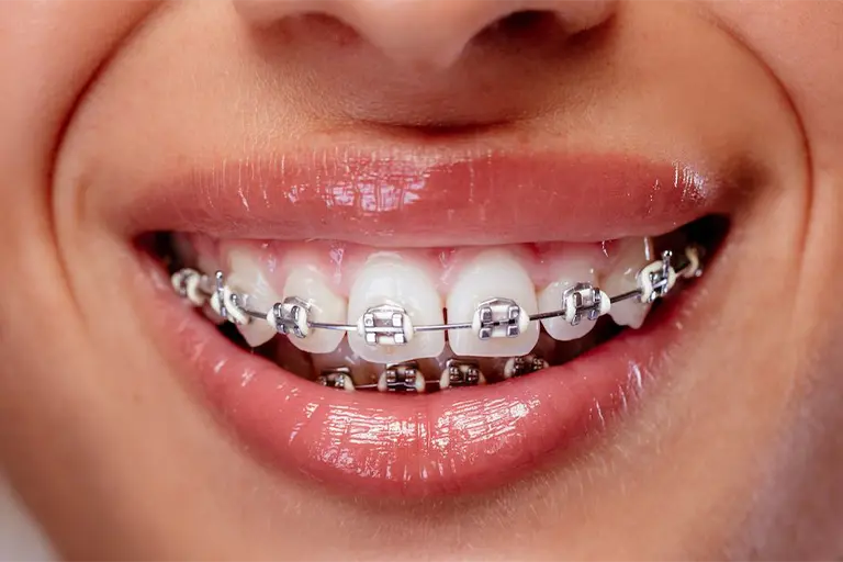 Removable orthodontic aligners vs traditional braces 