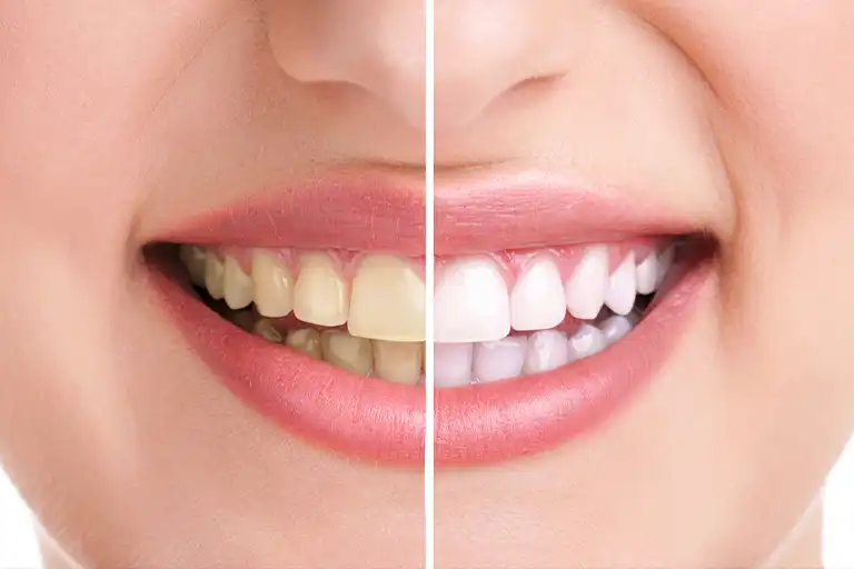 Hydrogen peroxide for teeth whitening 