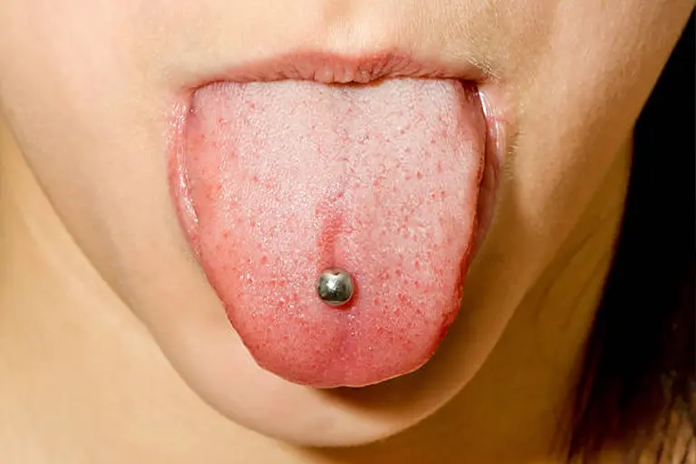 Tongue piercing risks