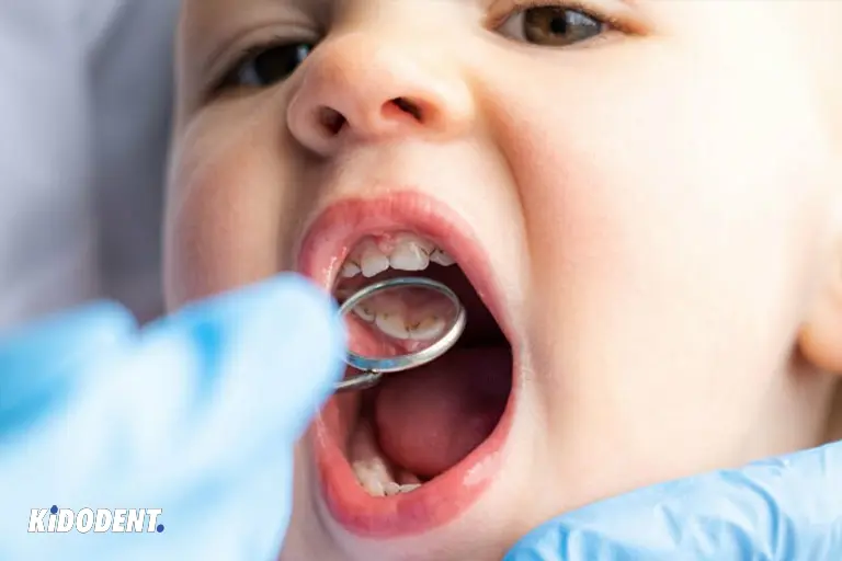 children tooth decay treatment options