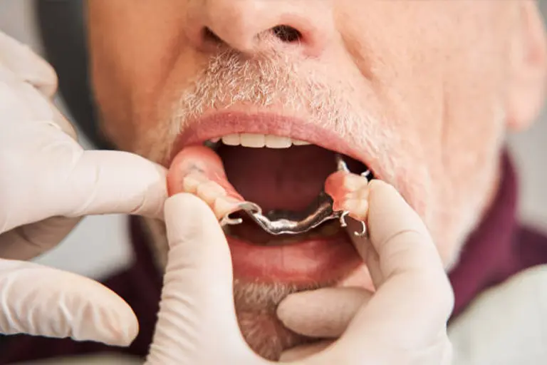 Denture stomatitis causes