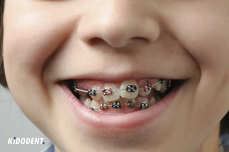 fix crooked teeth in children