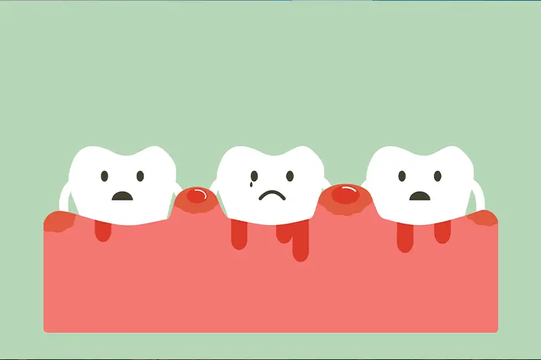 Bleeding gums and inflammation are common gingivitis symptoms.